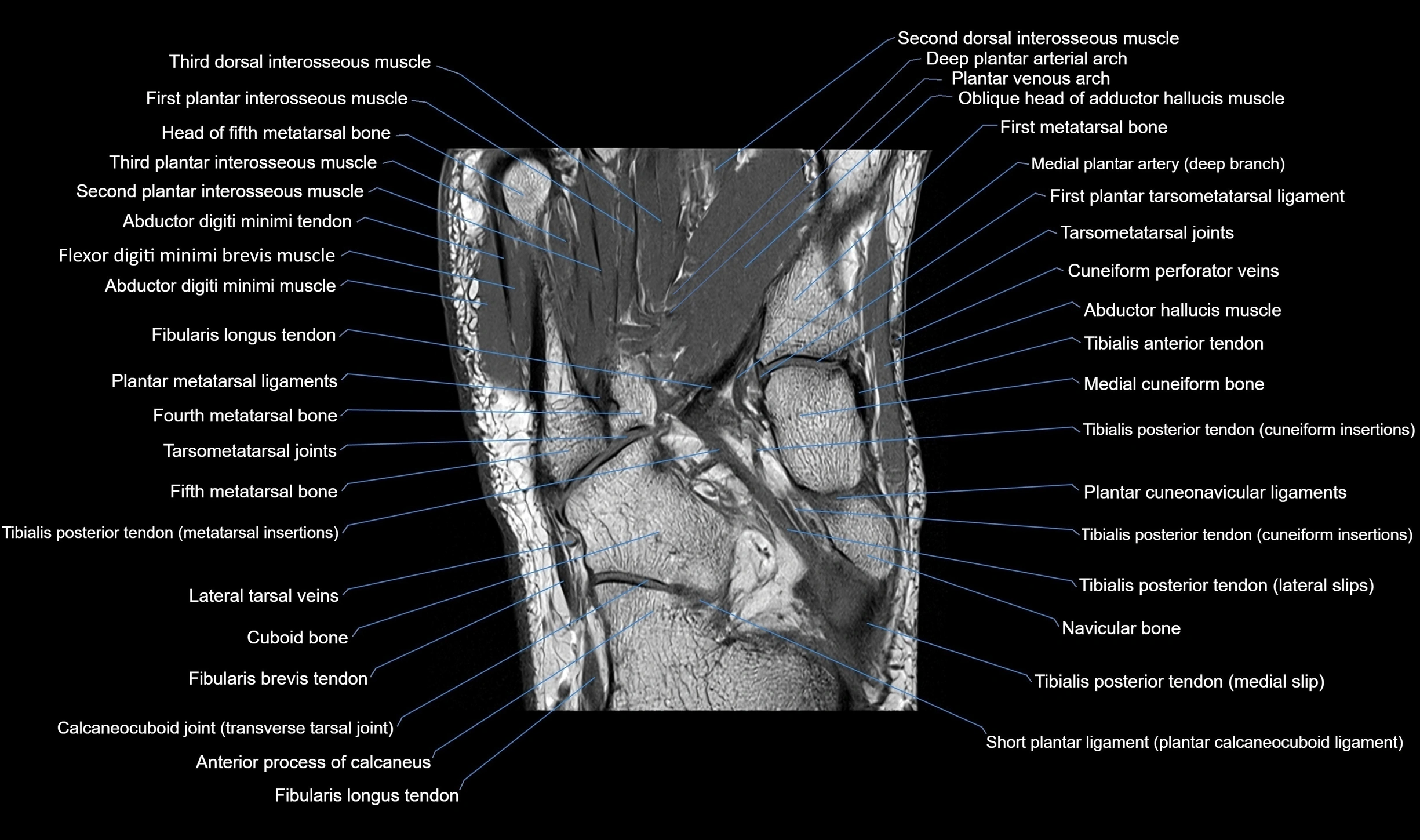 MRI mid foot coronal ligaments cross sectional anatomy 3T  radiology  image-img-00001-00026.webp